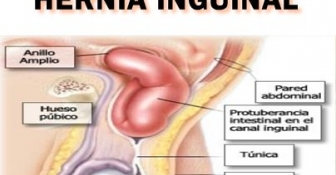 Las mejores fajas para la hernia inguinal