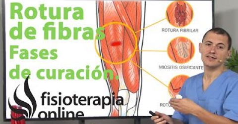 Fisioterapia en el desgarro muscular, qué es y cuales son sus causas y tratamiento